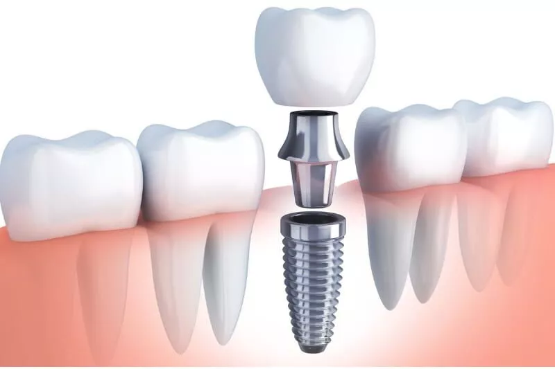 Croasdaile-Dental-Arts-dental-implants