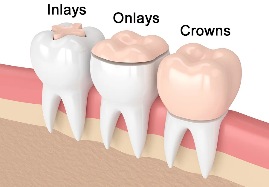 Dental-Inlays-And-Onlays