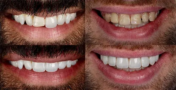 before-after-composite-bonding